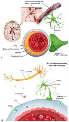 Neuroinflammation modifies the relationship between stress and perivascular spaces in an elderly population with different levels of cognitive impairment